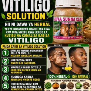 VITILIGO SOLUTION
