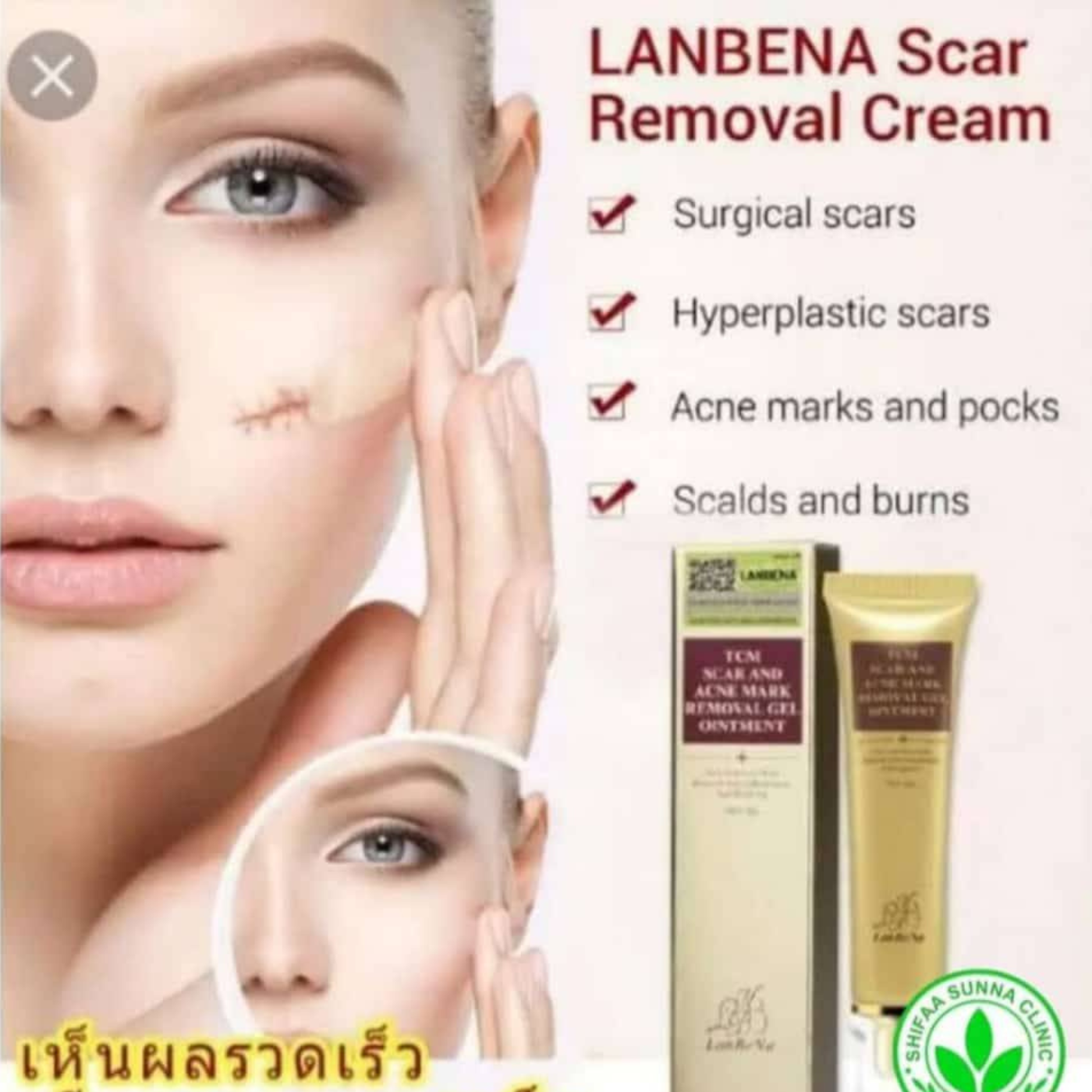 LANBENA REMOVAL