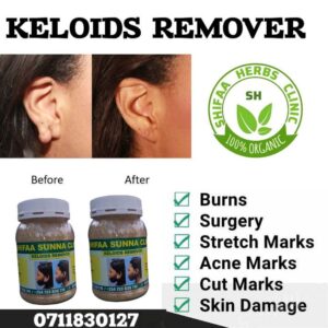 KELOIDS REMOVER OIL