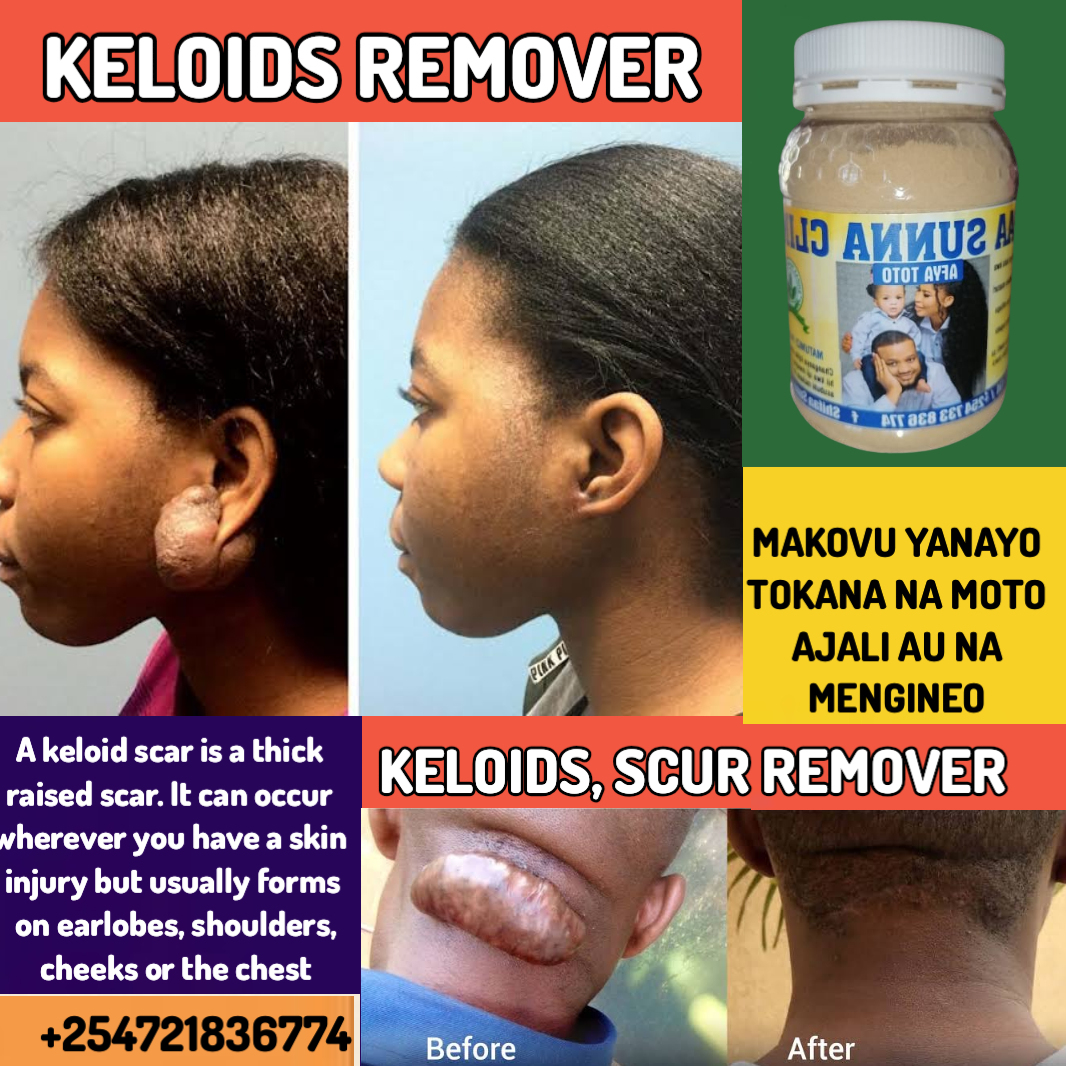 KELOIDS REMOVER - Image 2