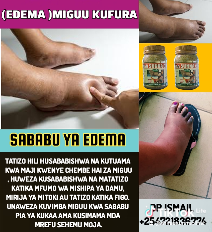 EDEMA SOLUTION - Image 2