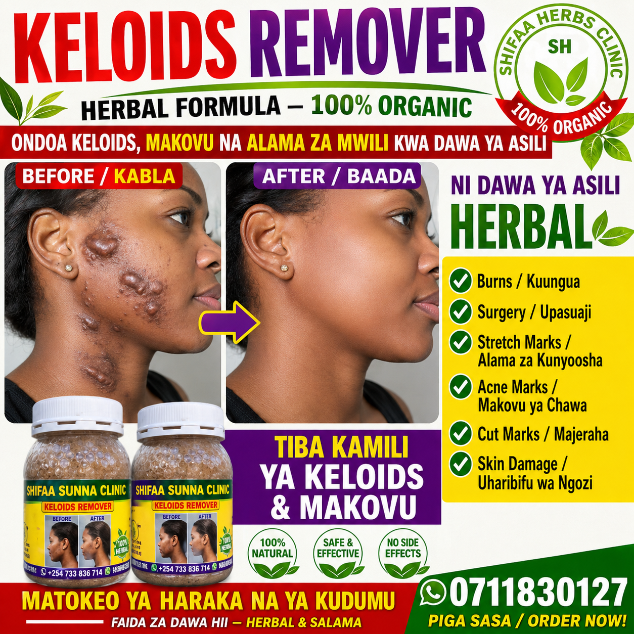 KELOIDS REMOVER