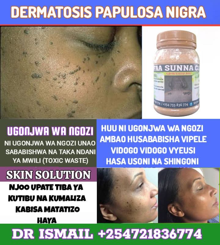 SKIN TAGS REMOVER - Image 2